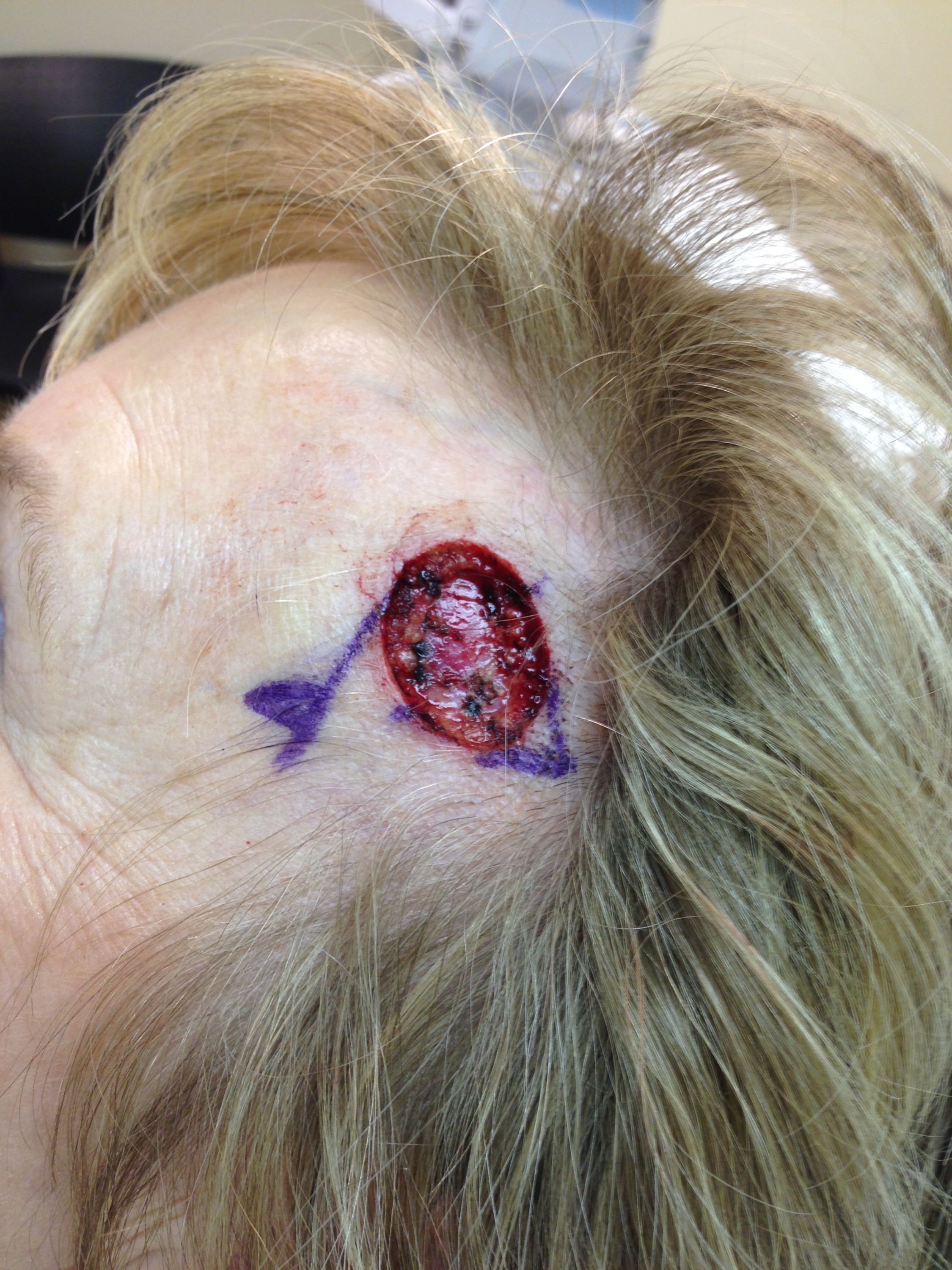 2014-03-05 10-57-32 Basal Cell Carcinoma surgery.jpg